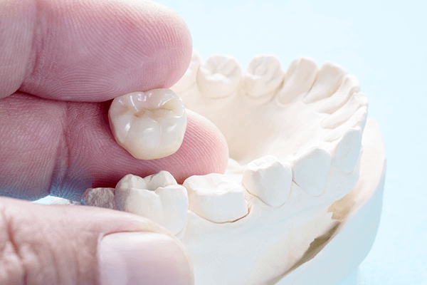 Dental Crowns Dental Crowns